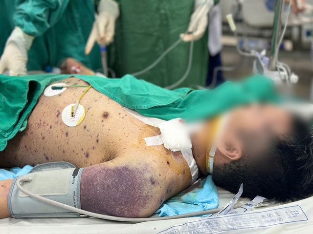 Hai thanh niên khỏe mạnh nguy kịch vì biến chứng thủy đậu- Ảnh 3.